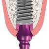 schematische Darstellung eines Implantats im Zahnfleisch