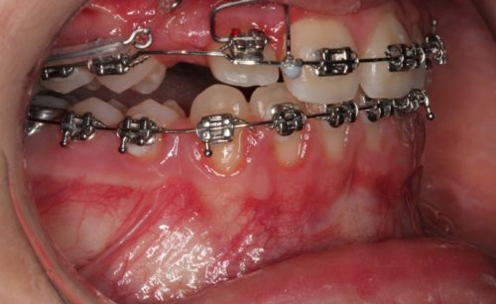 Burston-Torquefeder 1