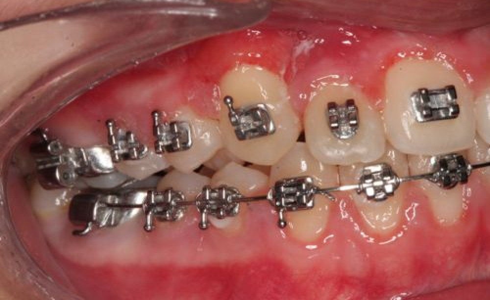 Brackets
