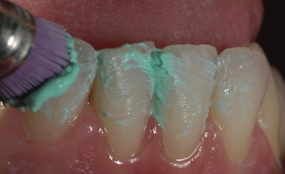 Abb. 3: Bereits das klinische Bild der Gingiva, die Rückkehr zur zartrosa Farbe, imponierte nach der Anwendung des Probiotikums. Gingiva behandelt mit Probiotikum