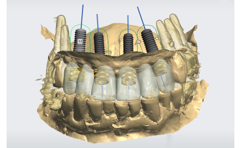 Pecanov Implantatprothetik 1 Trend 3D-Implantatplanung, DICOM meets STL