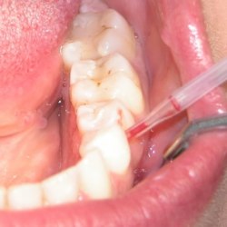 Hpv tumor rachen Papilloma in mouth nhs