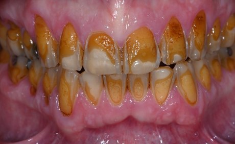 Sicht auf den Mund im Patienten mit fehlendem Schmelz