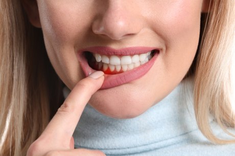 Frau zieht mit Finger Unterlippe herunter, um blutendes Zahnfleisch zu zeigen