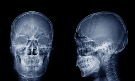 Zwei Röntgenaufnahmen vom Kopf, links frontal, rehts der linken Seite